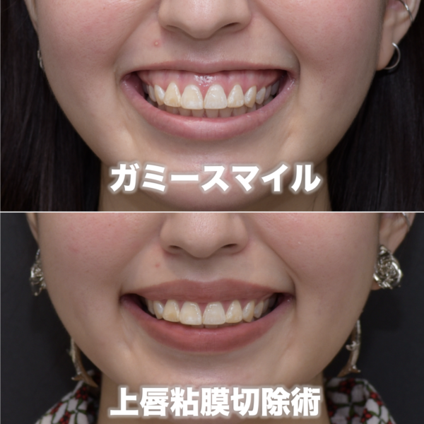 奥歯まで歯茎が見えるガミースマイルを治療した症例（上唇粘膜切除術）
