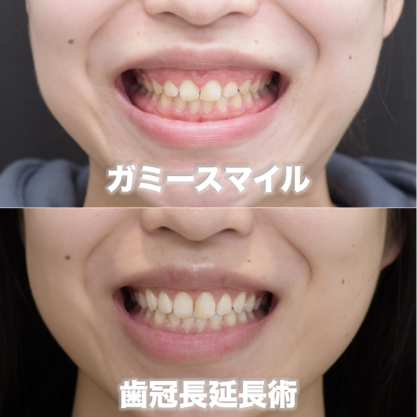 正常よりも歯が４mm短いガミースマイルを治療した症例（歯冠長延長術）