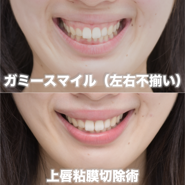左右で歯茎の見える量が違うガミースマイルを治療した症例（上唇粘膜切除術）