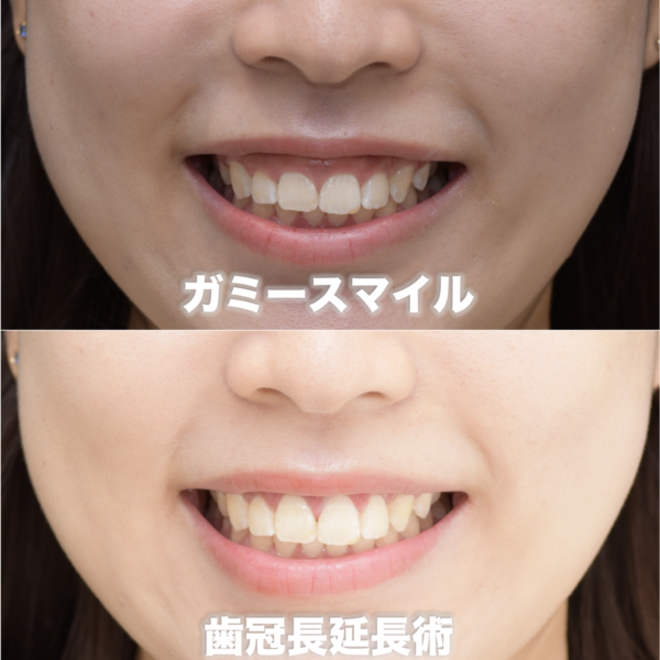 歯の長さが正常の６割しかないガミースマイルを治療した症例（歯冠長延長術）