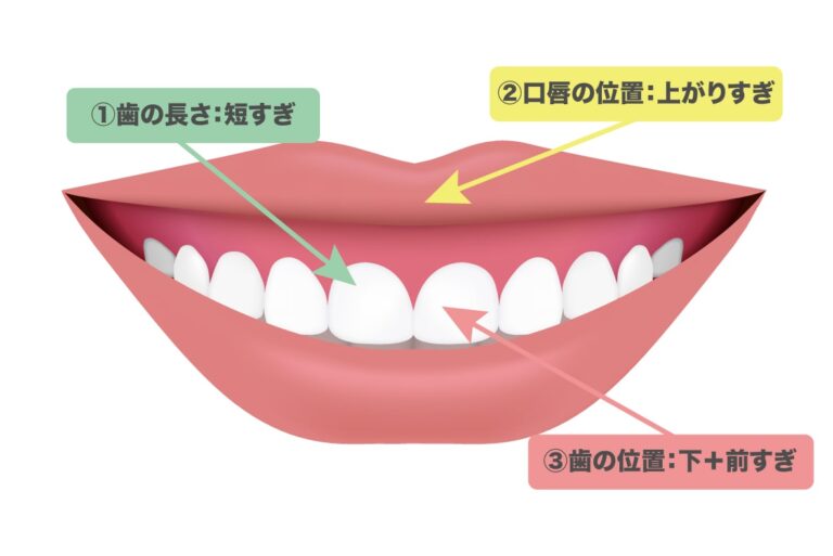 笑うと上唇が内側に丸まり薄くなるガミースマイルを治療した症例(上唇粘膜切除術)