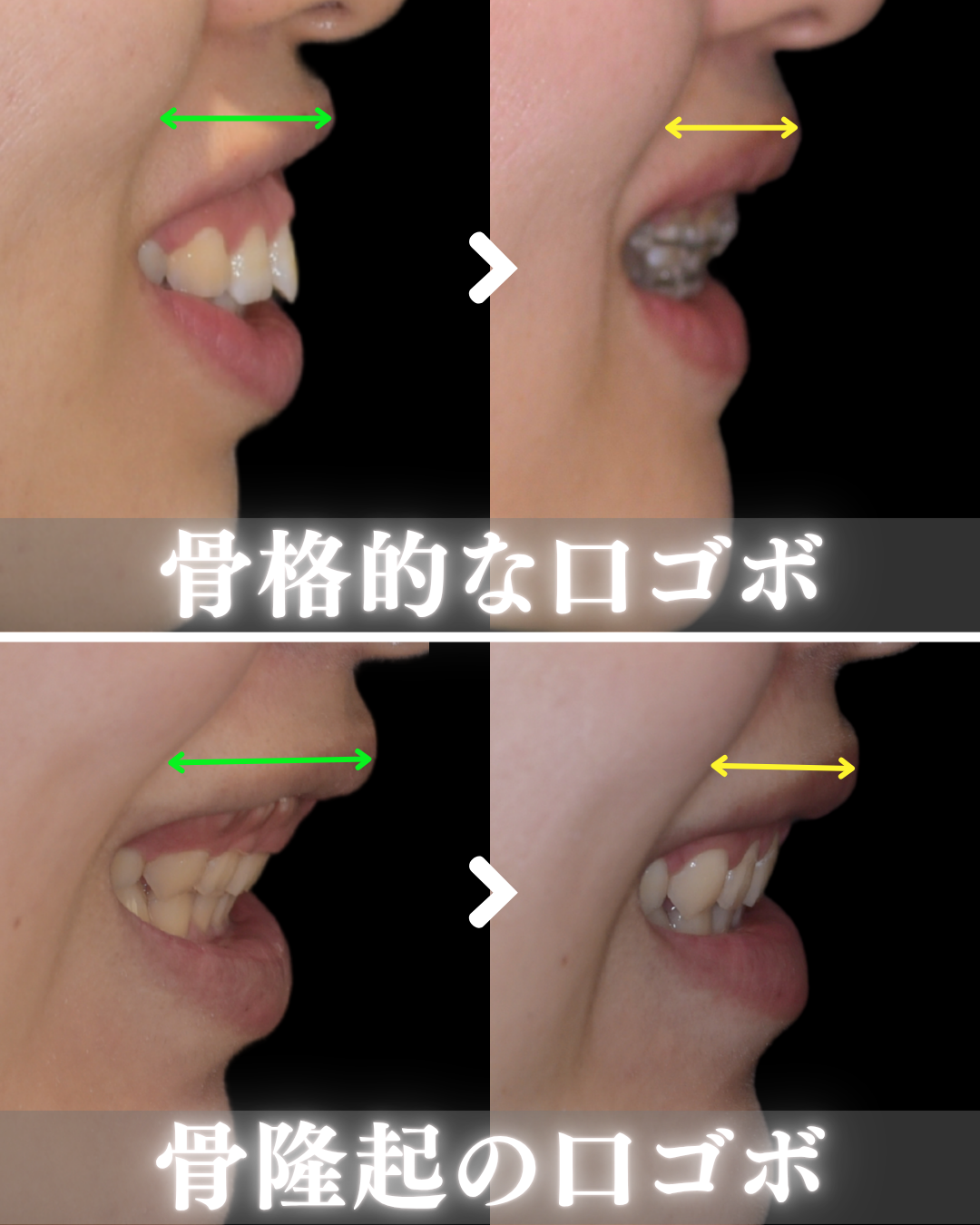 image_tooltip 口ゴボ