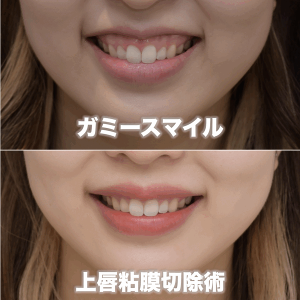 笑うと上唇が薄くなるガミースマイルを治療した症例（上唇粘膜切除術）