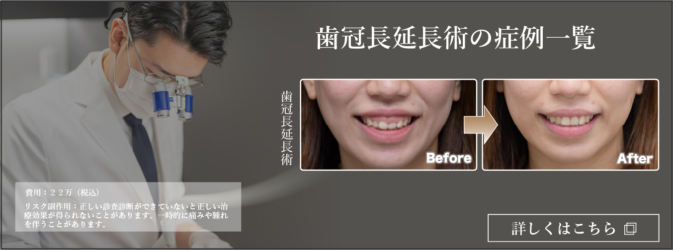 歯冠長延長術の症例一覧