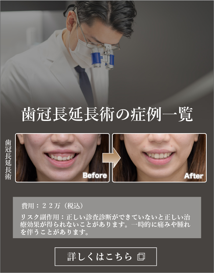 歯冠長延長術の症例一覧