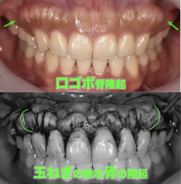 ガミースマイルとは？笑うと歯茎が3mm以上見える状態