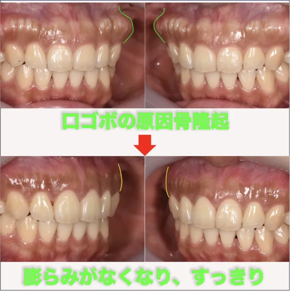 ガミースマイルになる原因は？主な4つの原因