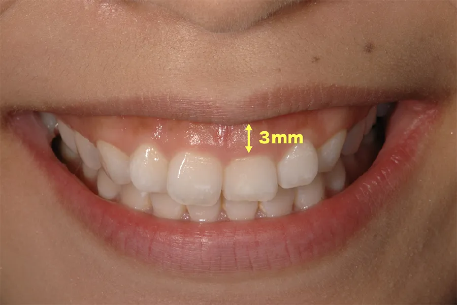 ガミースマイルとは？笑うと歯茎が3mm以上見える状態