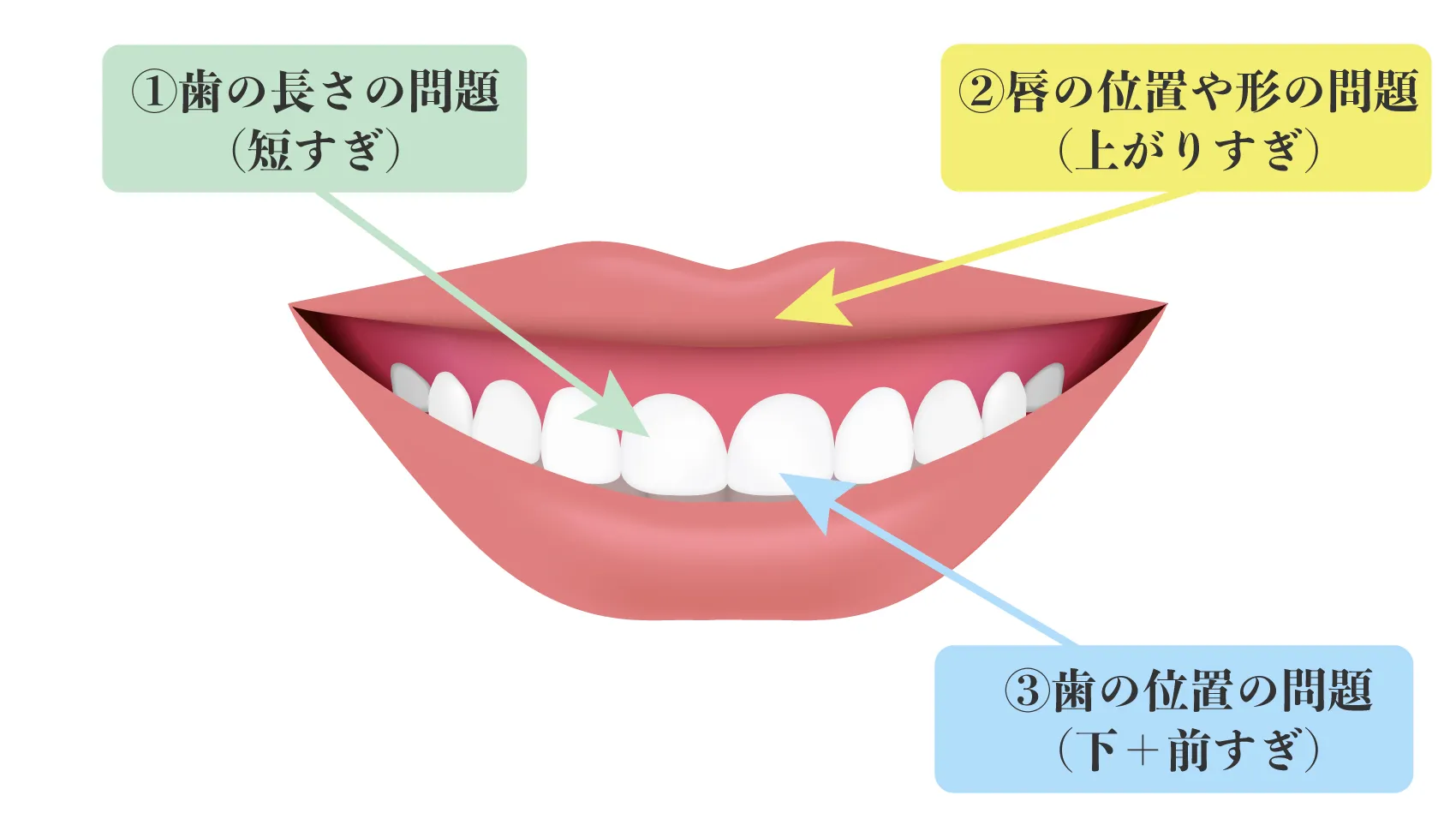 ガミースマイルになる原因は？主な4つの原因