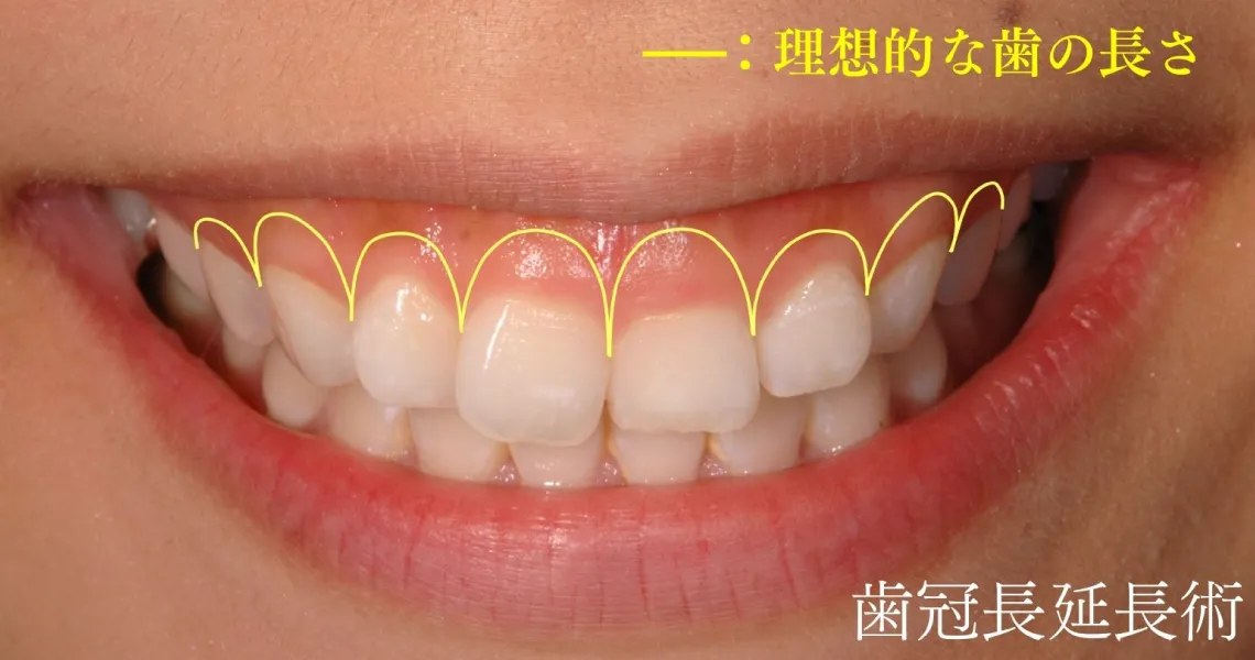 歯冠長延長術