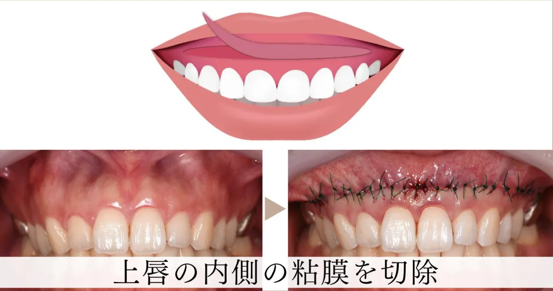上唇粘膜切除術