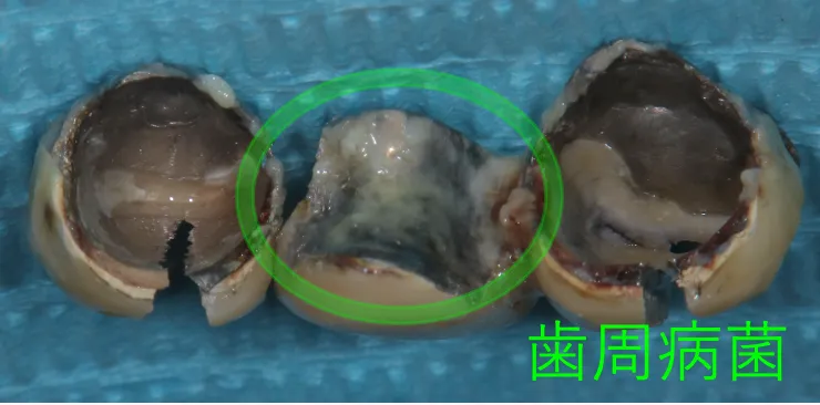 歯周病の原因