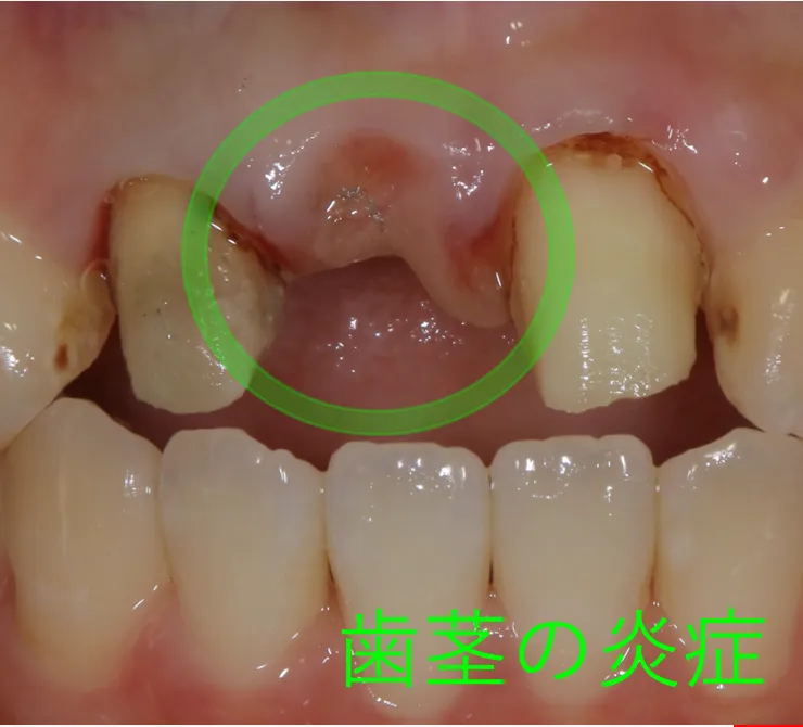 歯周病の原因