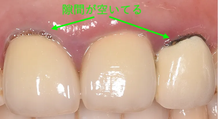 メタルボンド
