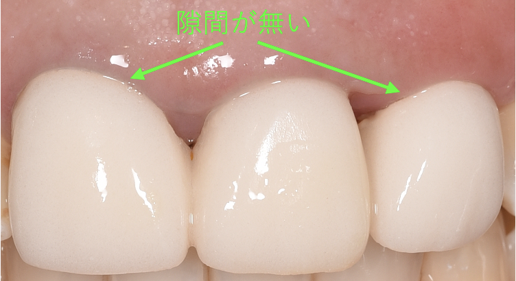 樹脂の仮歯