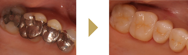奥歯の銀歯（４本）をセラミックで治療した症例