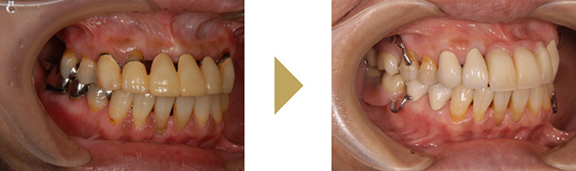 精密義歯（入れ歯）で治療した症例