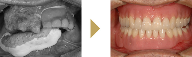 最小限の本数のインプラントを使用した入れ歯治療の症例