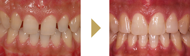 前歯4本の歯を削らずに行ったダイレクトボンディングの症例