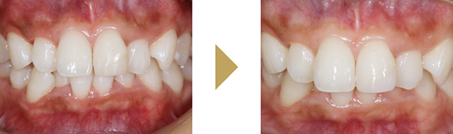 左上前歯のダイレクトボンディングの症例