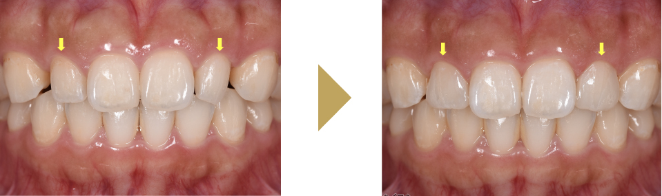 すきっ歯２本をダイレクトボンディングで治療した症例