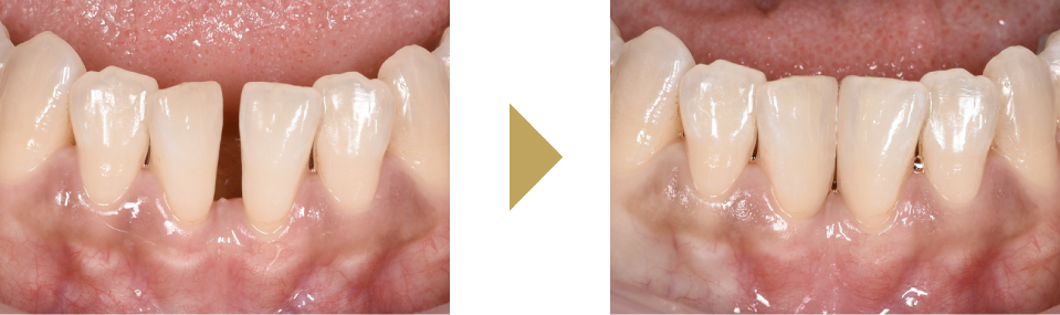 下の前歯のすきっ歯をダイレクトボンディングで治療した症例