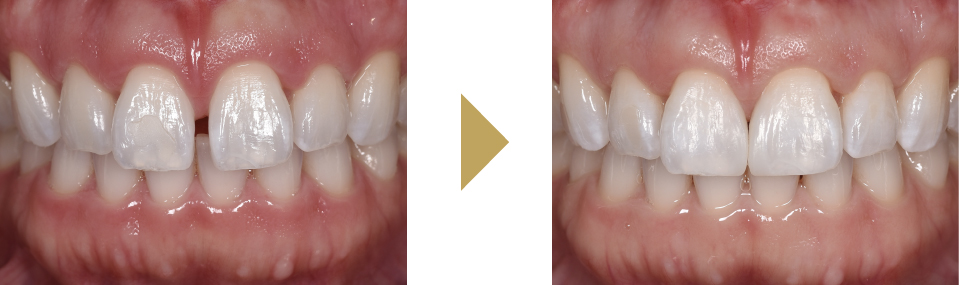 上の前歯のすきっ歯をダイレクトボンディングで治療した症例