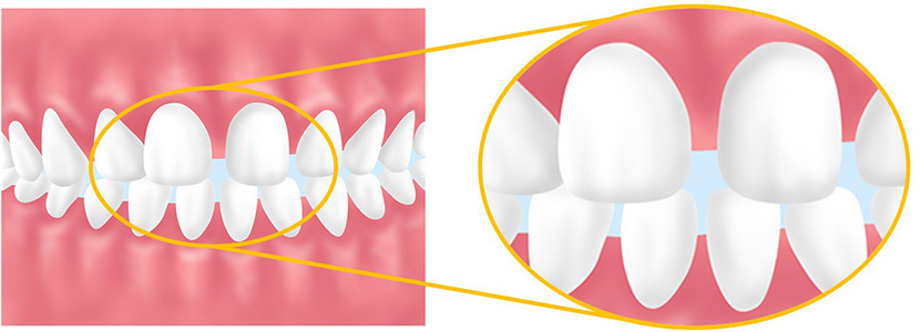 すきっ歯の改善