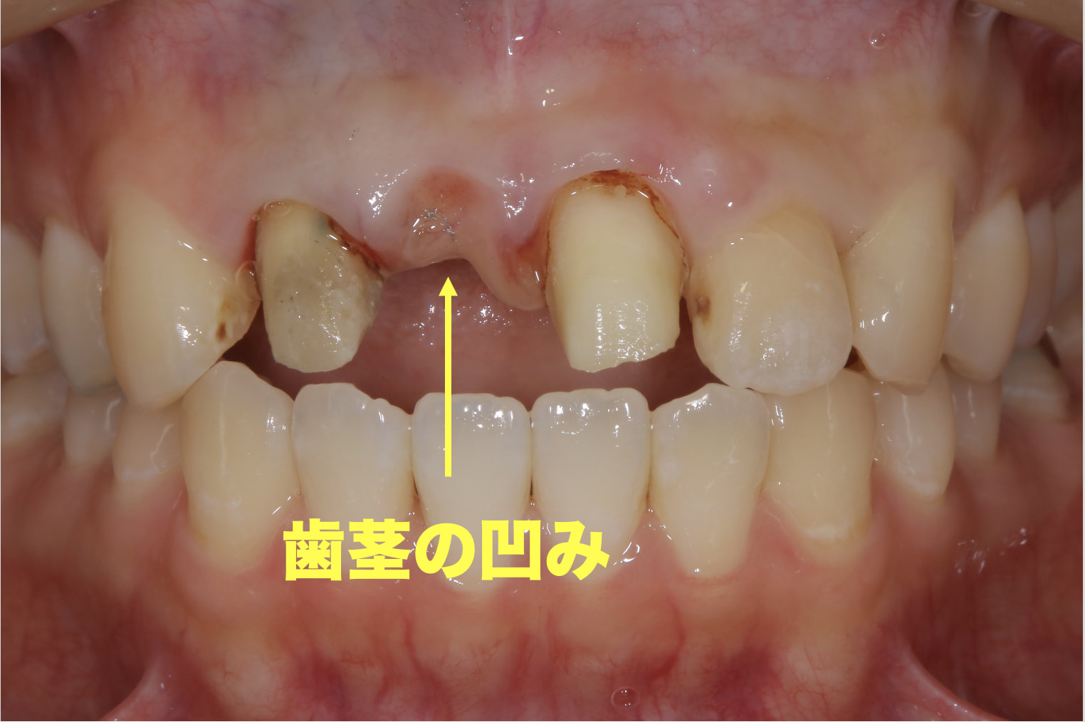 症例：凹んだ歯茎からブリッジを除去した写真。歯茎が萎縮して痩せているのがよりよくわかる