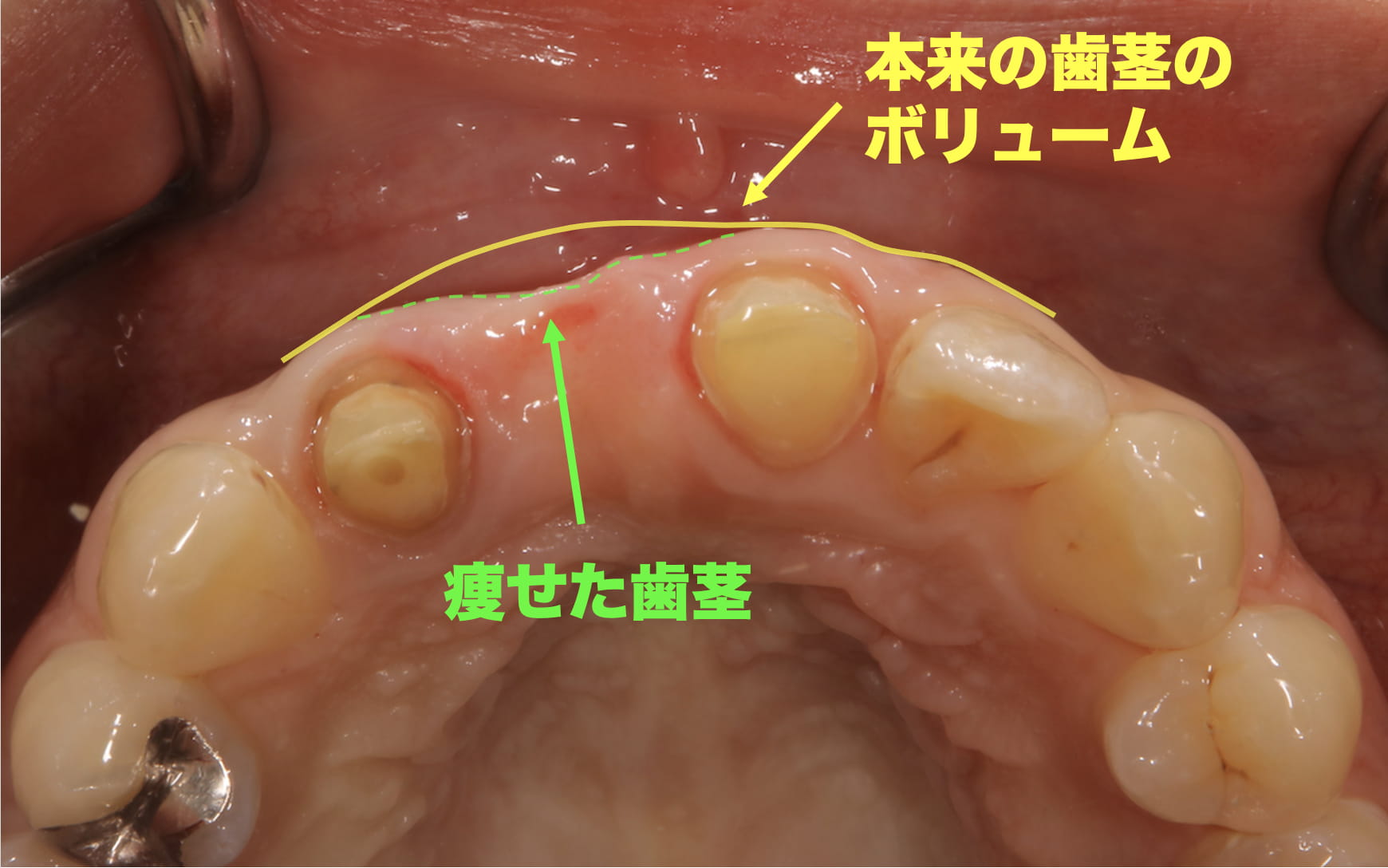 健康な歯茎のボリュームと痩せて凹んだ歯茎のボリュームを比較する症例写真