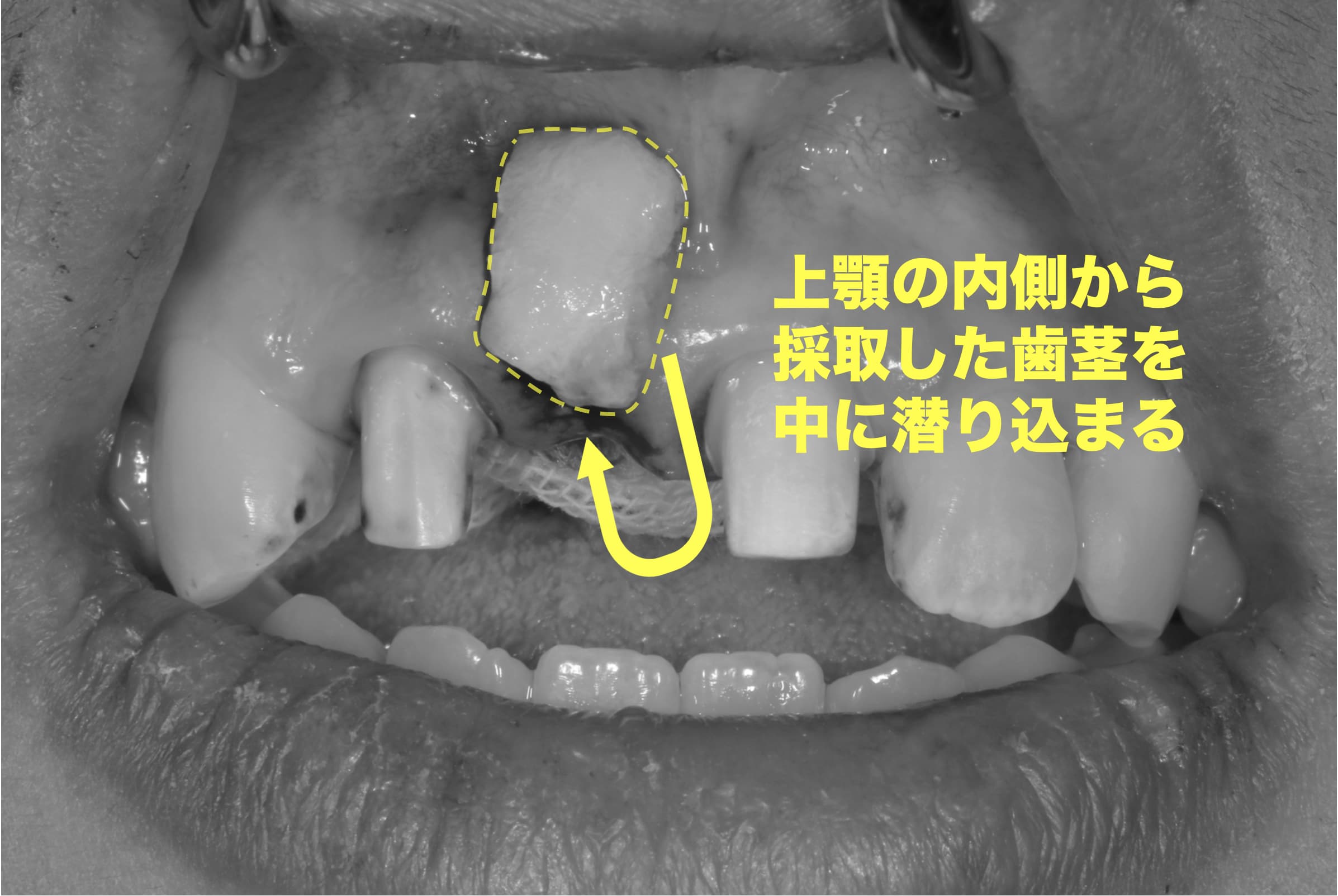採取した歯茎の組織を凹んだ歯茎の中に移植する症例写真
