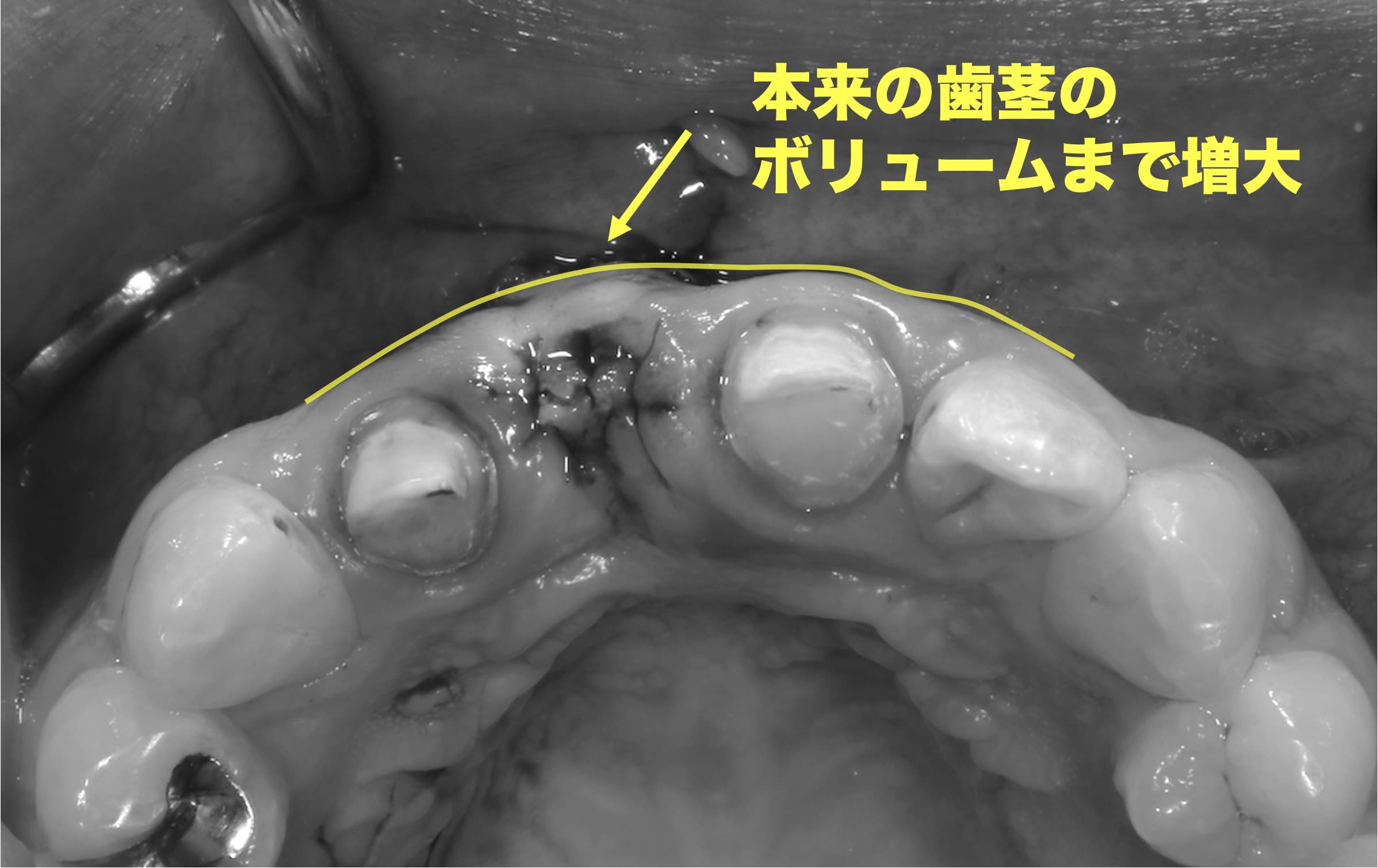 結合組織移植により凹んだ歯茎がボリュームを増大した状態の症例写真