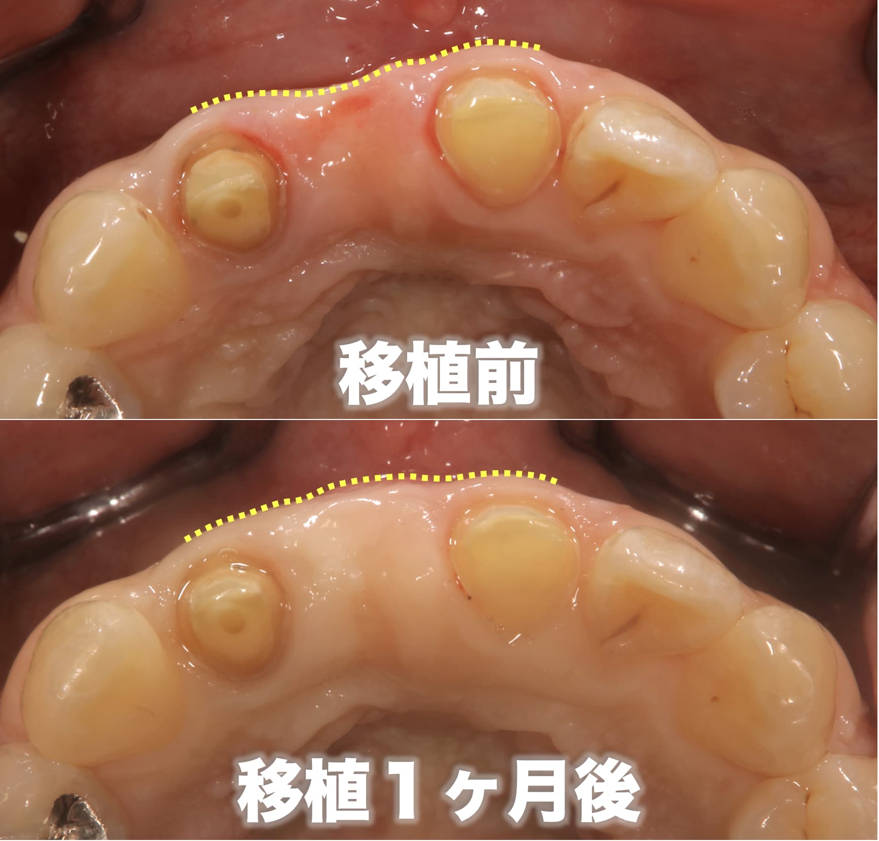 歯茎の組織を移植する前後一ヶ月の歯茎のボリュームを比較した症例写真