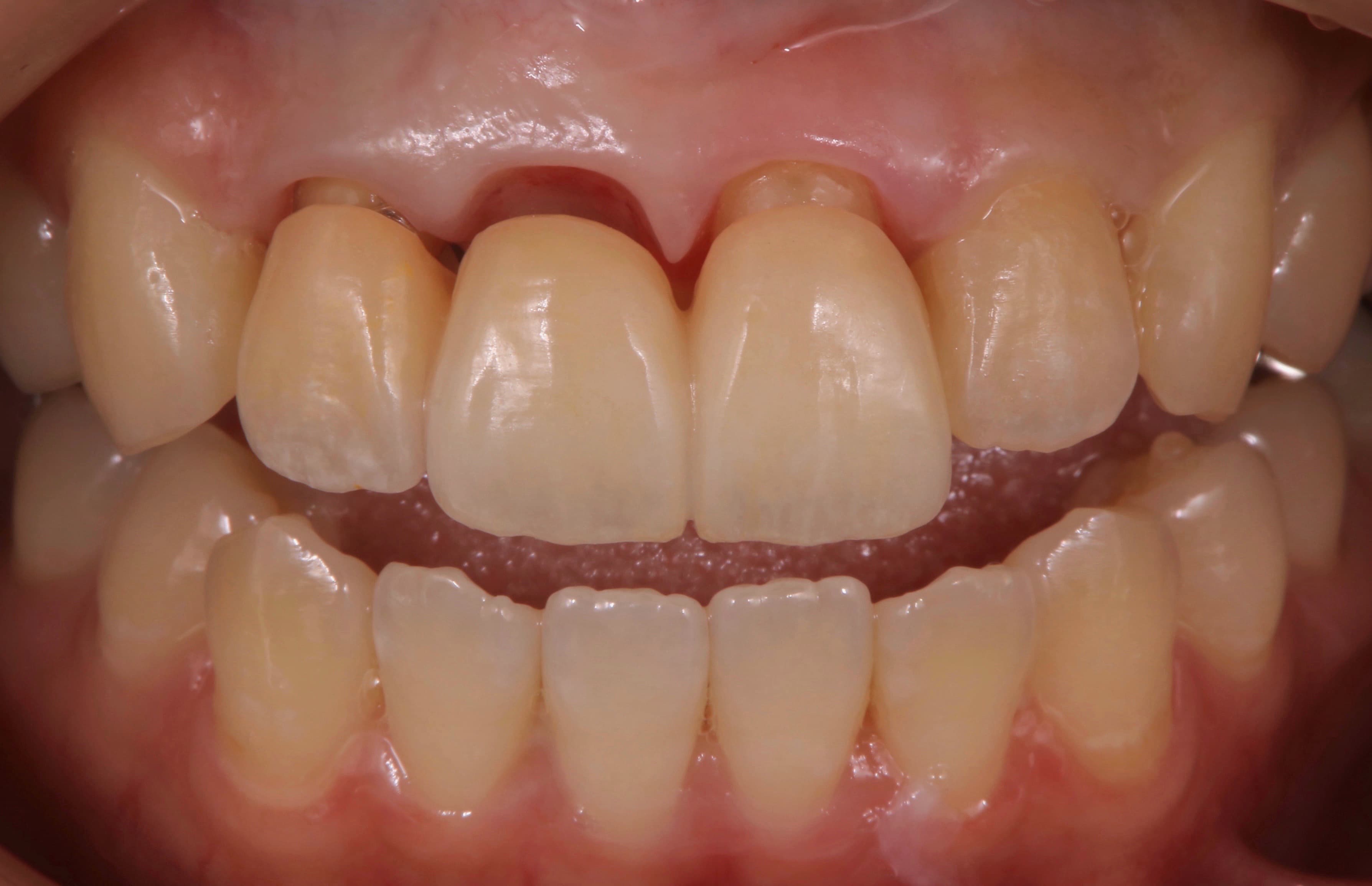歯茎の整形後、ブリッジ装着直前の歯茎の状態の症例写真