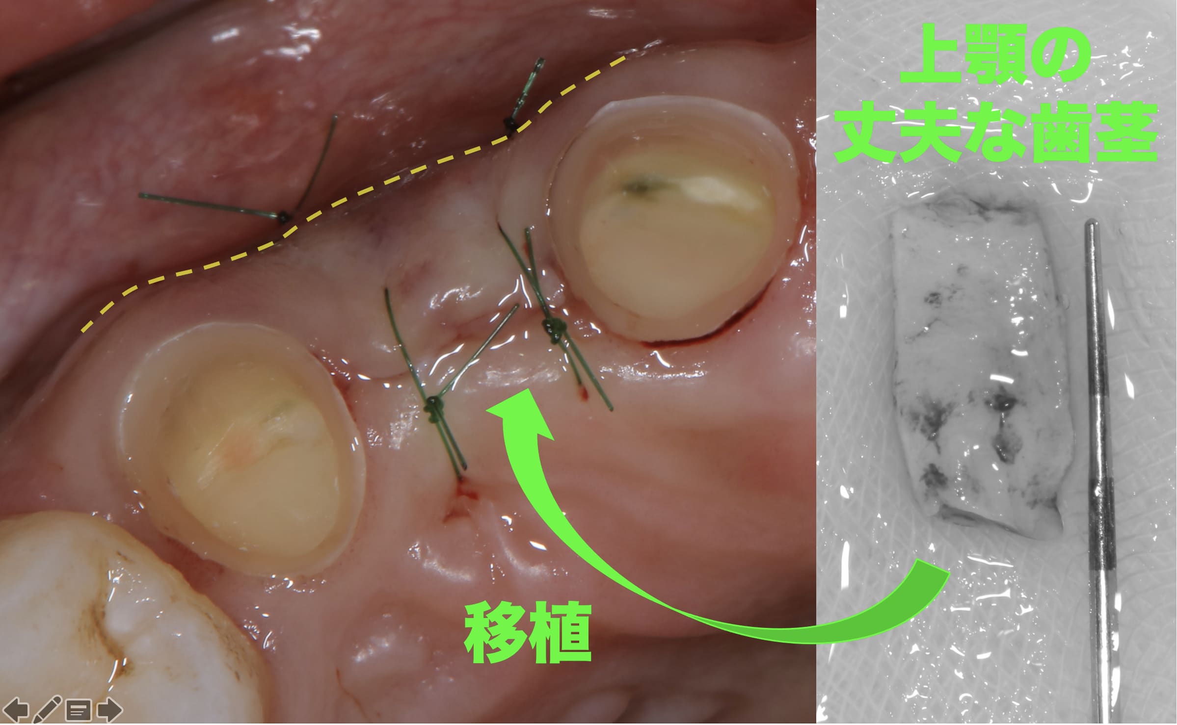 凹んだ歯茎へ丈夫な歯茎を移植した直後の症例写真
