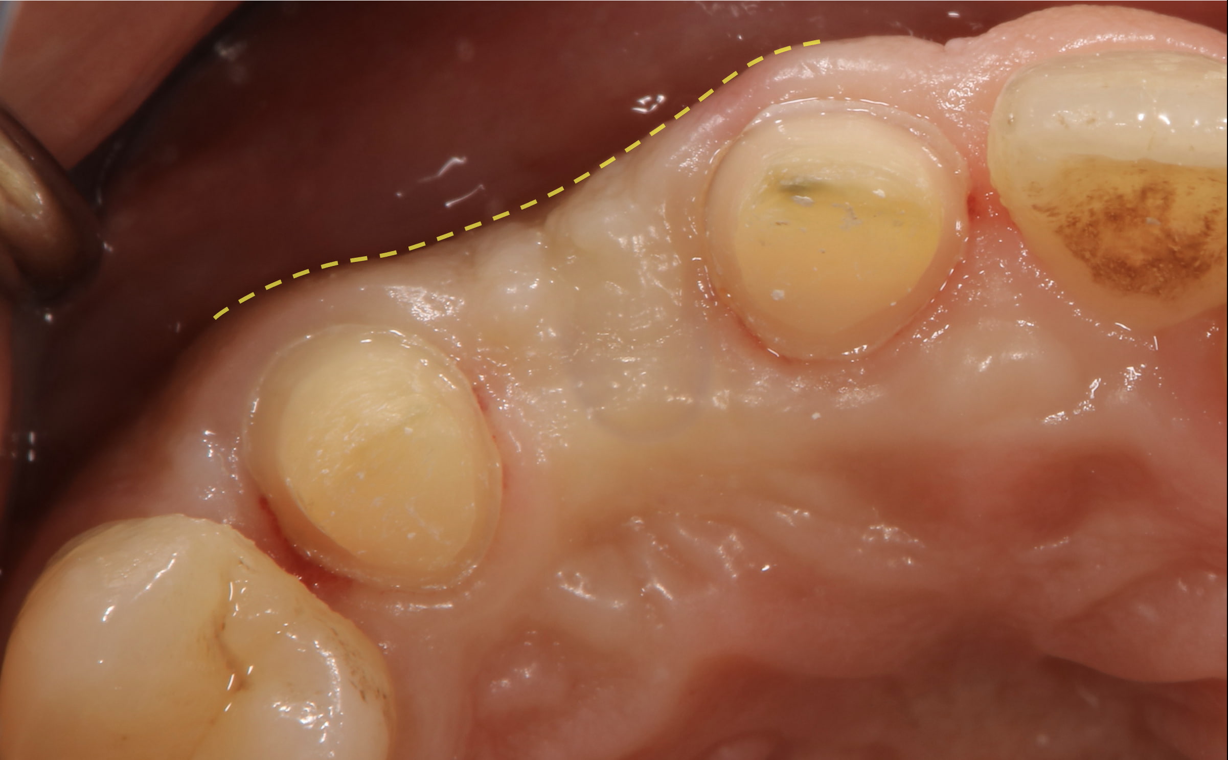 凹んだ歯茎へ丈夫な歯茎を移植した1ヶ月後の症例写真