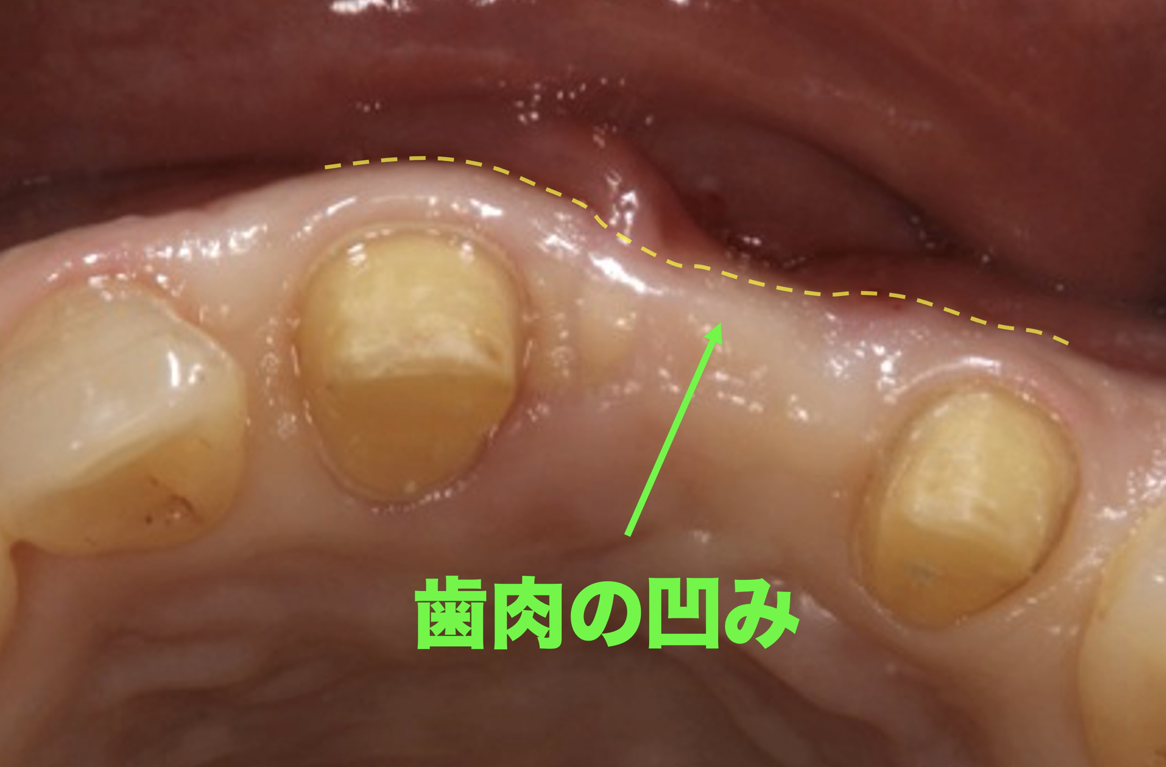 歯茎の凹みと溜まった汚れにより歯周病になってしまった歯茎の症例写真
