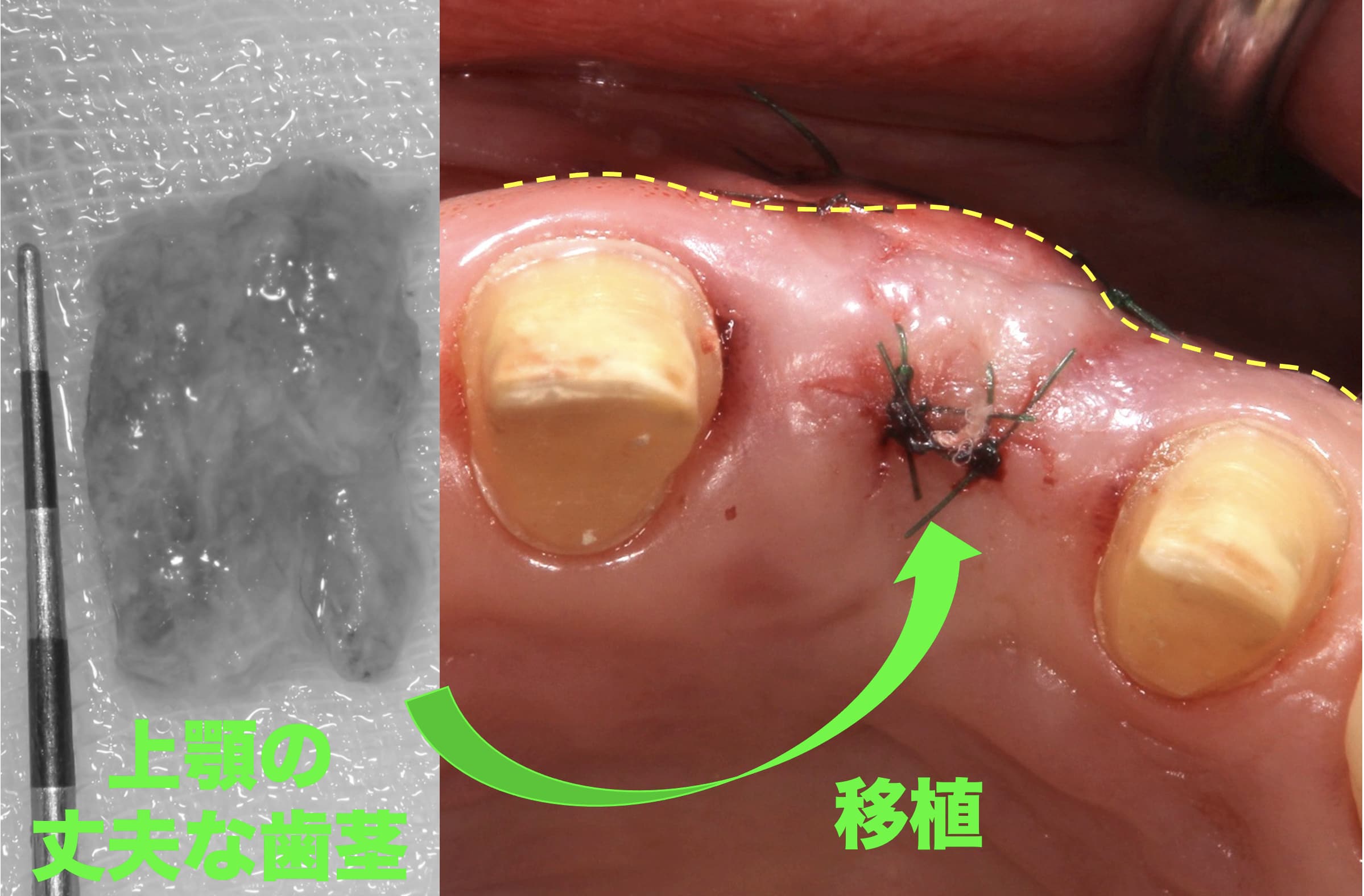 凹んだ歯茎に歯周病治療と歯茎の移植をおこなった直後の症例写真