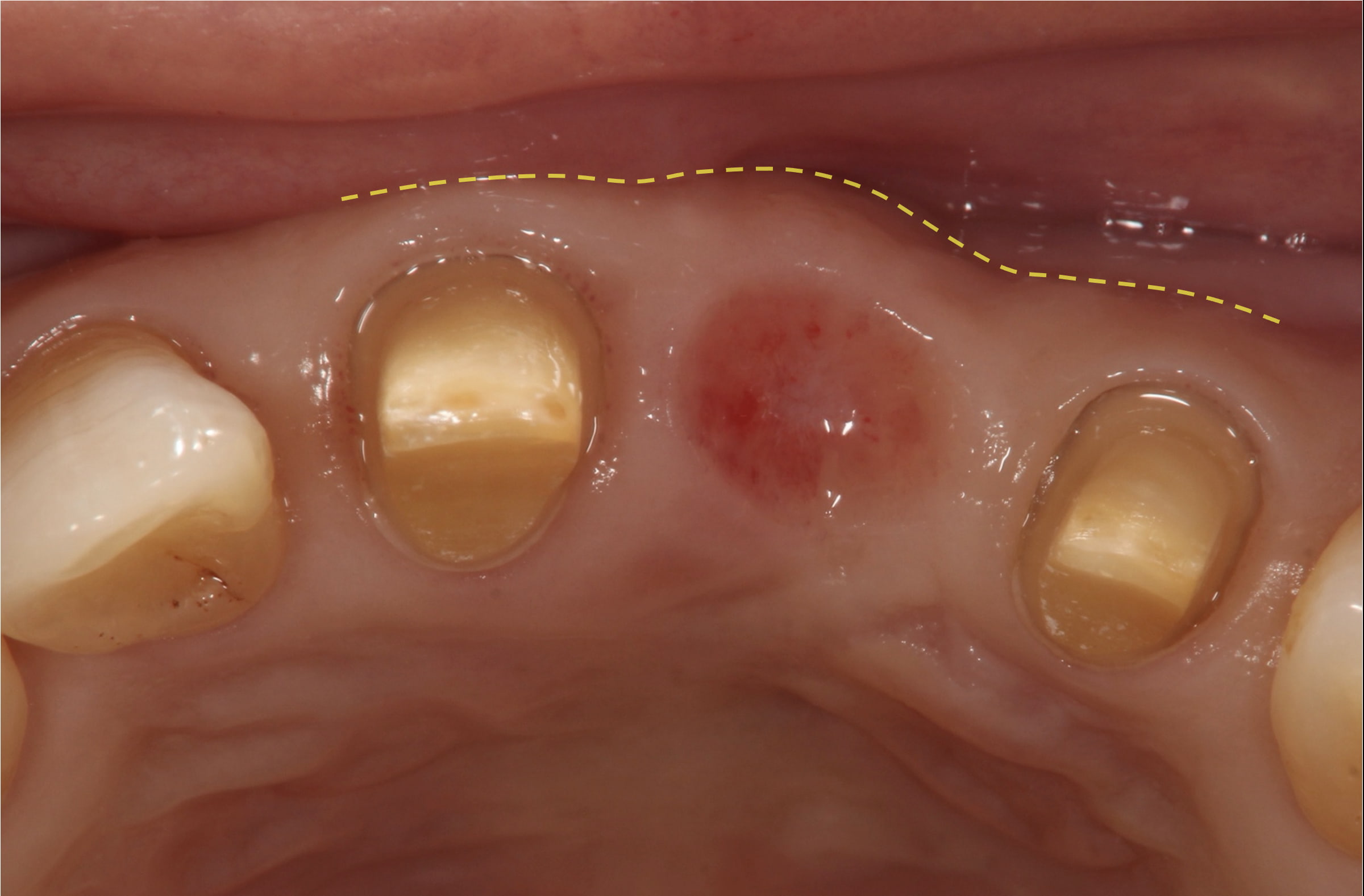 凹んだ歯茎に歯周病治療と歯茎の移植をおこなって3ヶ月後の症例写真