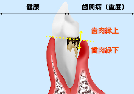 歯周病の診断方法