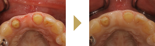 失われた歯肉のボリュームを戻す歯周形成外科の症例