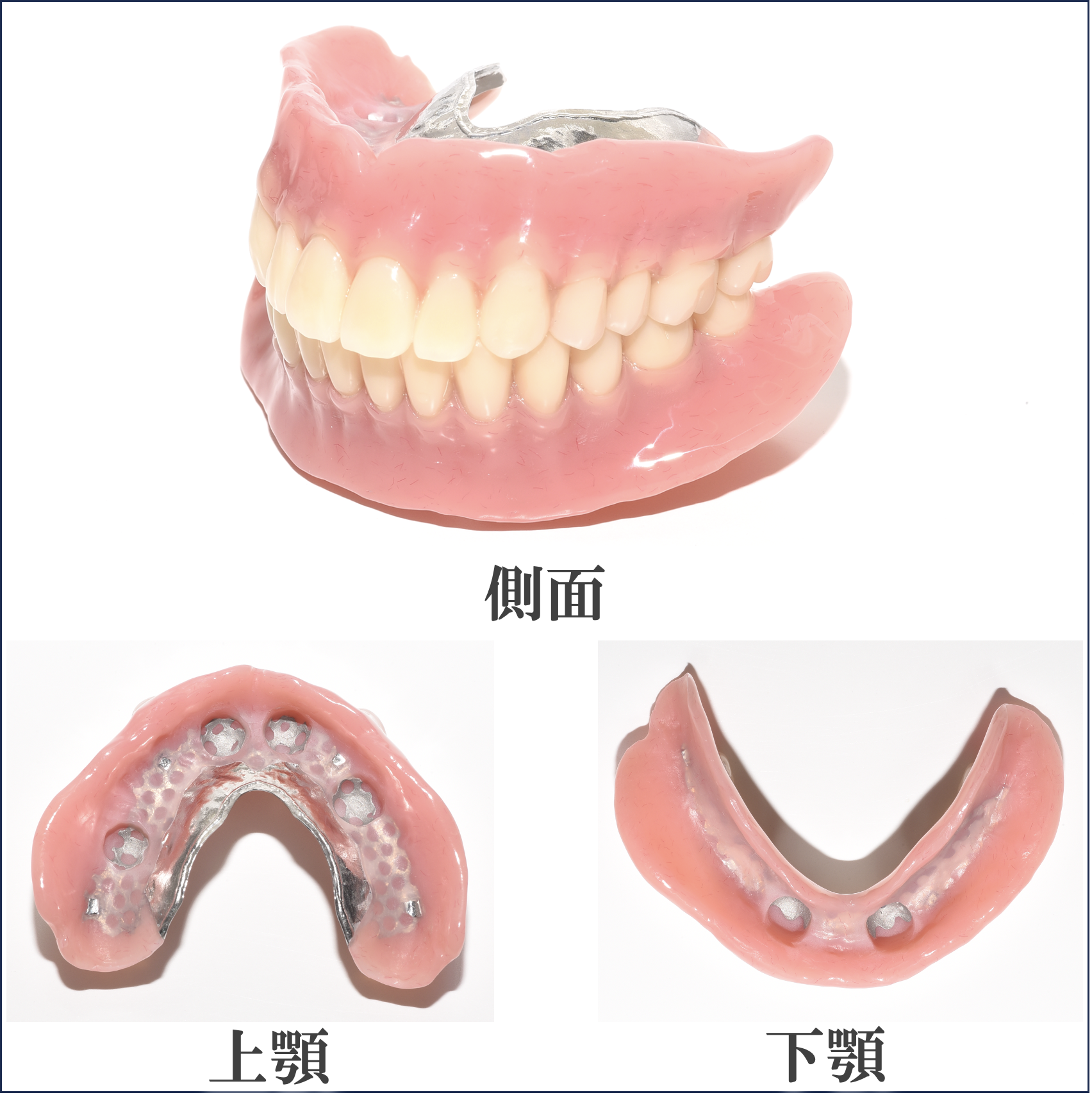 インプラントオーバーデンチャー専用の特殊義歯の作成