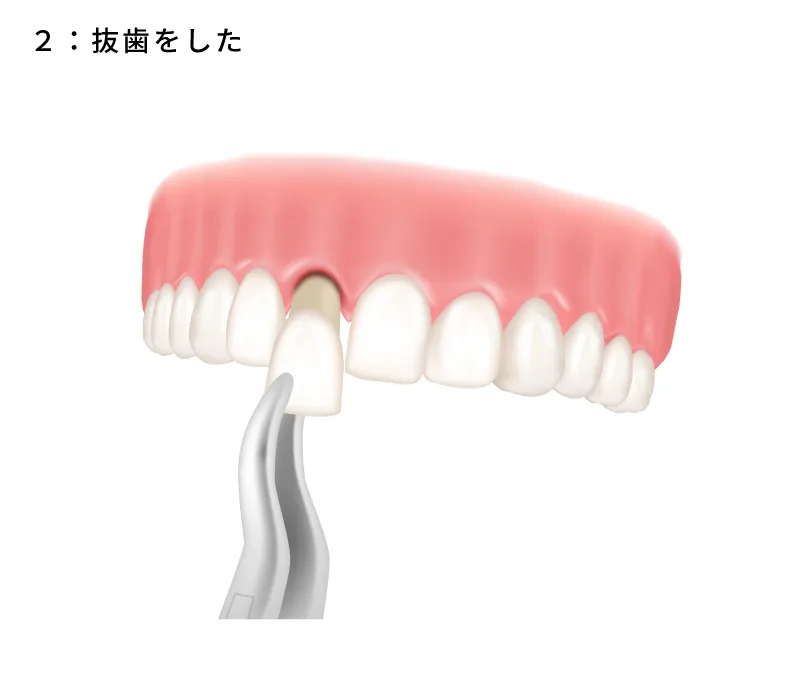 保存が難しい歯の抜歯