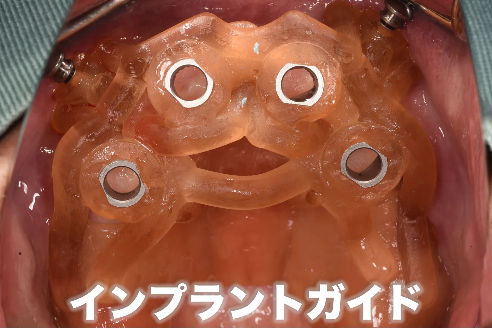インプラントガイドの作成