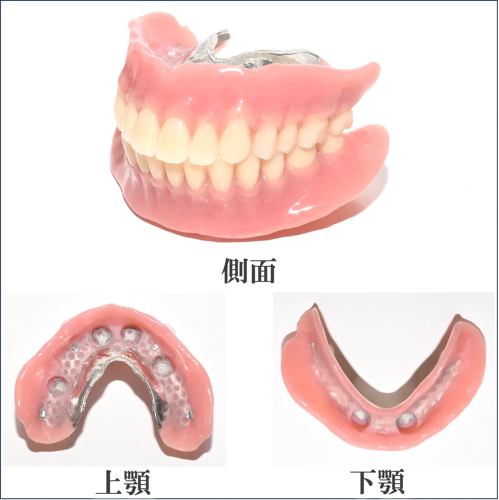 ２次手術（インプラントの頭出し）
