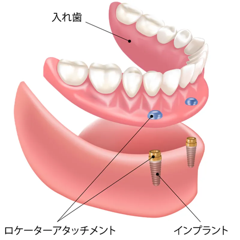 インプラントオーバーデンチャーの仕組み