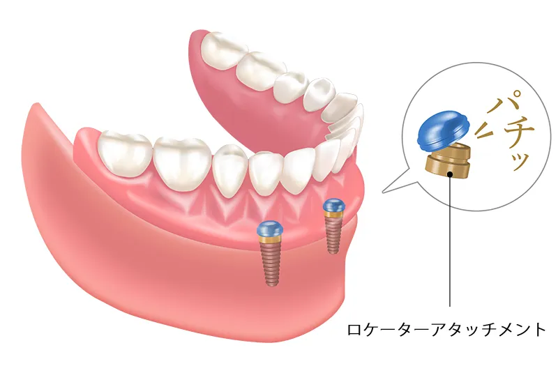 アバットメント