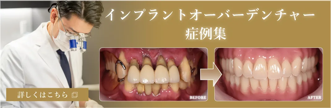 アバットメント