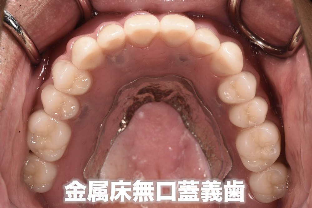前医で、上顎は「もう総入れ歯しかない」と言われた患者様を、インプラントオーバーデンチャーで治療した症例 - インプラントオーバーデンチャー専門 ...
