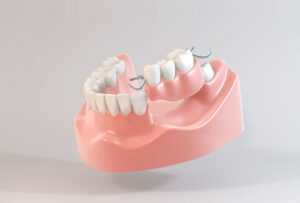 奥歯に入れ歯が必要な理由と奥歯におすすめの入れ歯について解説します